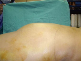 Butt Augmentation, Liposuction before 402324