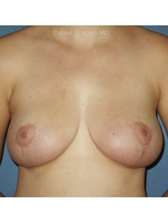 Bilateral Mastopexy after 249983