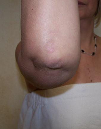 Arm Lift after 230663