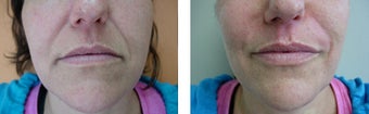 Juvederm before 561089