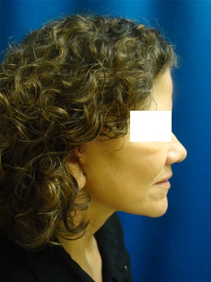 Neck and Face Lift Surgery after 157485