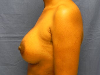 Breast Augmentation 364626