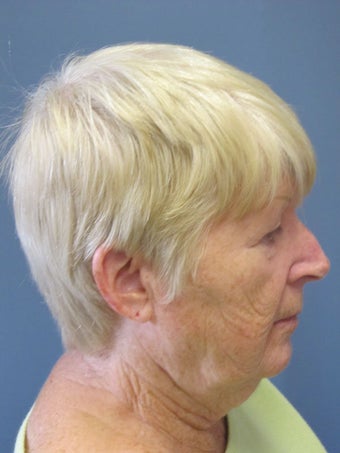 Neck Lift, Platysmaplasty 634731