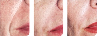 Aftefill injection before and after before 9593