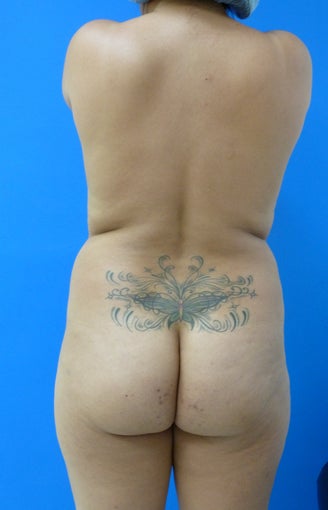 Brazilian Butt Lift before 367406