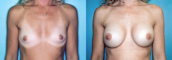 Breast Augmentation (34A to 34C) before 352791