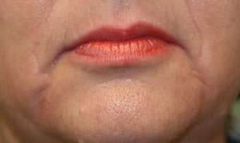 Restylane and Radiesse before 240864
