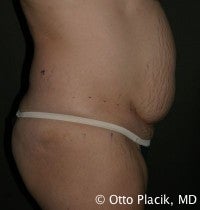 Abdominoplasty 565832