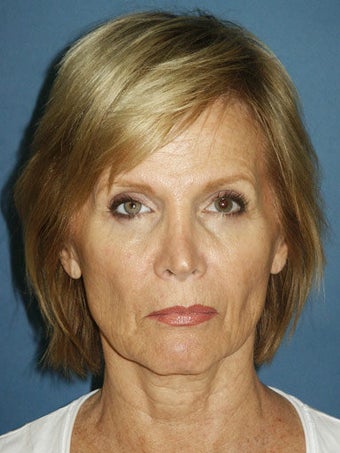 Facelift, Endoscopic Browlift, Upper and Lower Blepharoplasty, Perioral Dermabrasion before 248857