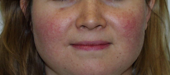 IPL Treatments before 354044