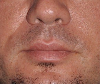 Lip Lift after 521702