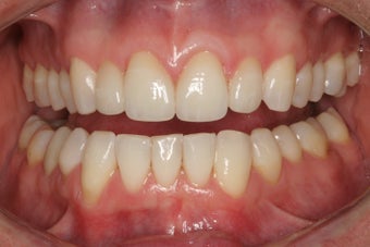 Tooth replacement in the smile 382033