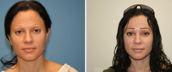 Fat transfer to face before 253846
