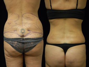 Smartlipo Triplex liposuction of the waist and flanks. Cellullaze of the buttocks and thighs before 602414