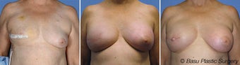 Breast reconstruction before 270825