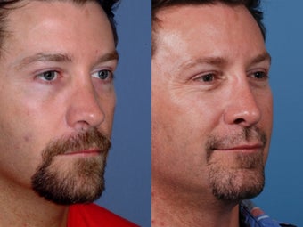 Revision rhinoplasty 355697