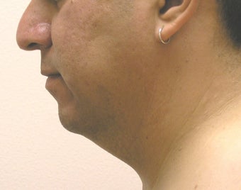 chin liposuction before 409998