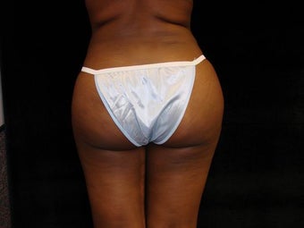 Buttocks Augmentation after 222568