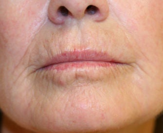 Lip lift, corner of lip lift, and laser treatment of wrinkles around lips before 299916