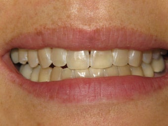 KOR Whitening before 307309