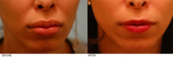 Silicone Lip Correction/Reduction before 164963