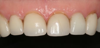 Porcelain Veneers and Crowns before 370188