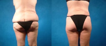 Lower Body Lift before 134105
