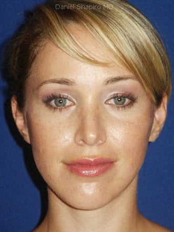 Rhinoplasty with sculpting of nasal tip and refinement of nasal dorsum. after 249027