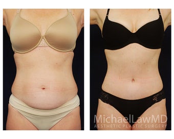 Abdominoplasty - Tummy Tuck before 396017