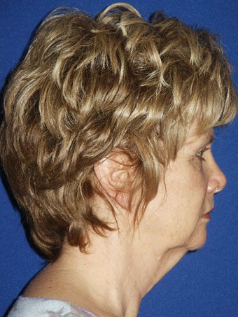 Facelift, Anterior Hairline Browlift, Upper and Lower Blepharoplasty, Perioral Dermabrasion before 248903