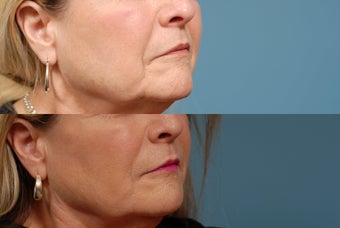 Sculptra after 409299