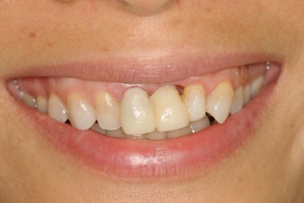 Ortho, dental implants, bone graft, gum graft, all porcelain veneers before 503156