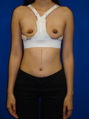 Breast Reconstruction Symmastia Repair after 121759