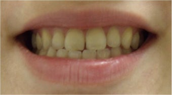 Zoom! Laser Whitening before 326051