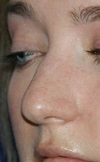 Rhinoplasty 390972