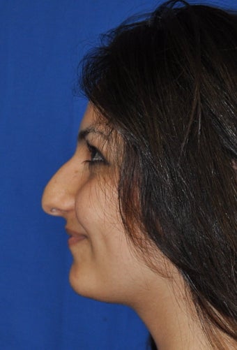 Rhinoplasty 373759