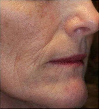 Fraxel - Photoaging before 652367
