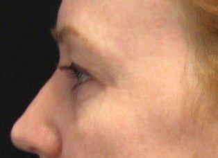 Fraxel CO2 Laser Resurfacing after 221155
