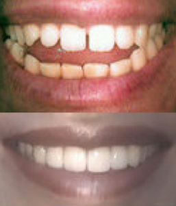 Porcelain Veneers before 109196
