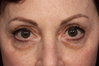 Restylane before 309247
