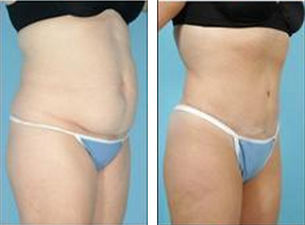 Tummy Tuck (Abdominoplasty) after 324853