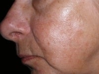 Intense Pulsed Light after 272101