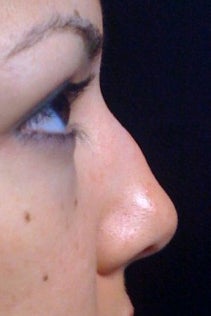 Lunch Time Nose Job using Radiesse before 152207