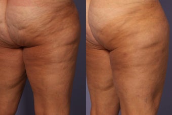 Cellulaze before 607929