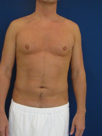 Vaser Hi Def Liposuction before 248823