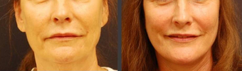 Facelift before 406749
