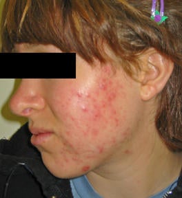 Laser Acne Treatments before 82943