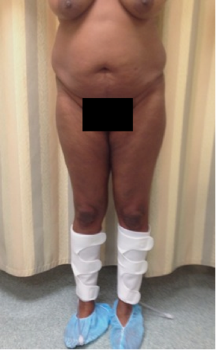 Liposuction and Fat Injection before 526160