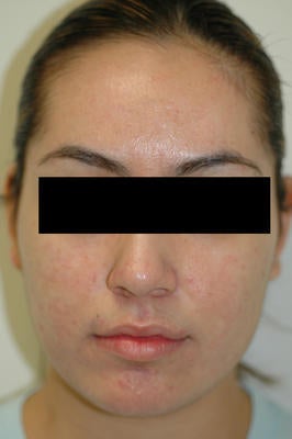 Laser Acne Treatment after 82948
