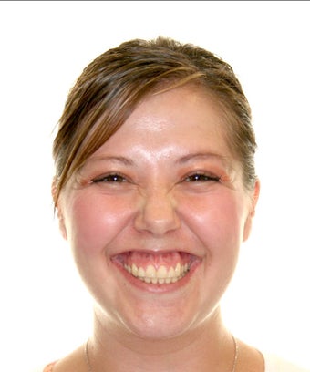 Surgical Orthodontics before 344747